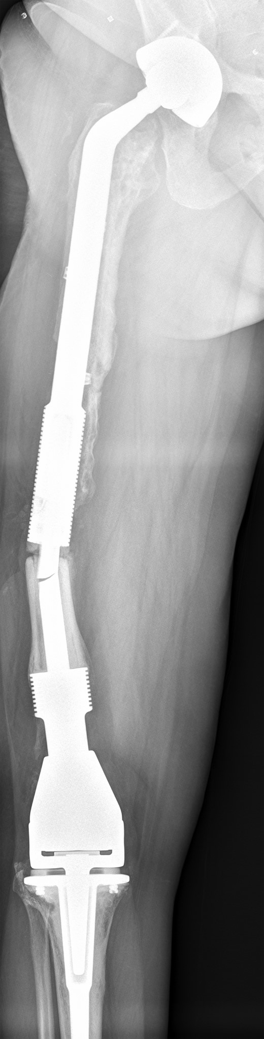 Full length femur radiograph illustrating fatigue fracture in stem of original distal femoral component.