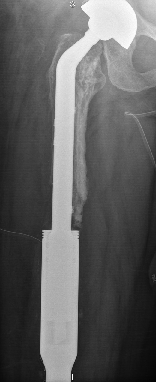 Retained proximal femoral component with new custom-made cement-linked distal femoral prosthesis visible in lower half of the image.
