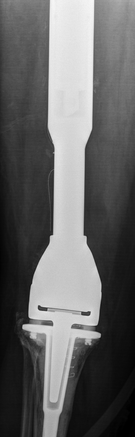 New custom-made distal femoral prosthesis cement-linked to original salvage proximal femoral component visible in upper half of the image.