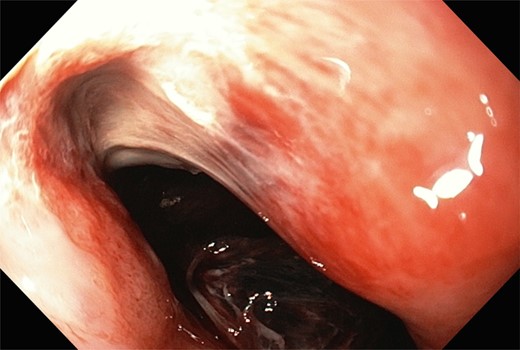 A large Mallory–Weiss tear and large fundal clot were observed during gastroscopy.