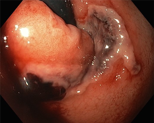 During the last gastroscopy, a fundal gastric ulcer and a larger and deeper Mallory–Weiss tear were noted.