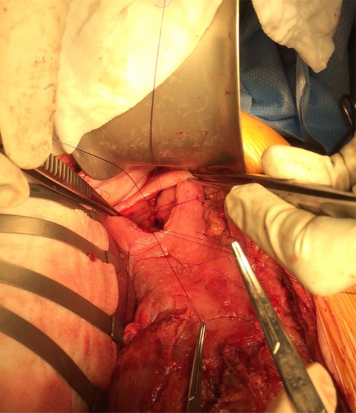 The gastric ulcer was excluded from the rest of the stomach through gastrostomy using 3/0 PDS suture.