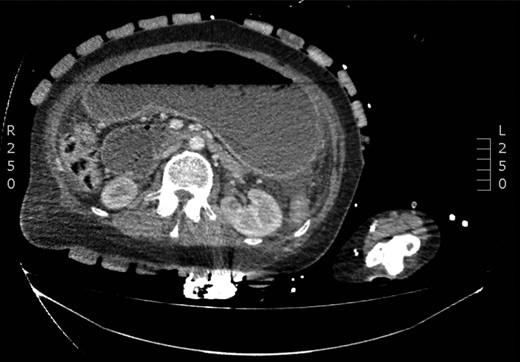 A CT scan of the abdomen showing the dilated stomach.