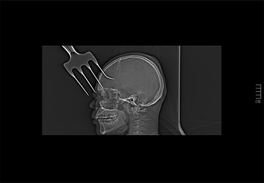 CT scout view showing a retained garden fork in the frontal area.