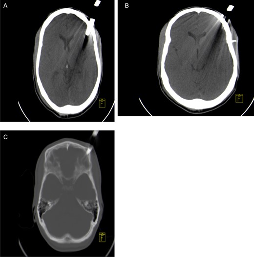 Axial non-contrast CT brain scan showing a garden fork prong in the left frontal parenchyma with associated artefact (A) and loose bone fragment in left frontal soft tissue (B). Axial CT bone window showing left frontal bone fracture caused by the fork (C).