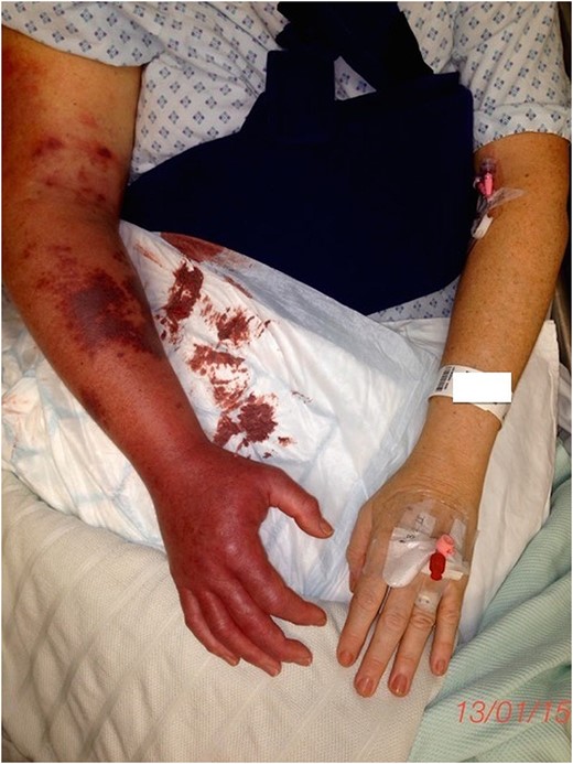 Right upper limb 7 h after orthopaedic surgery.