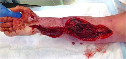 Emergency fasciotomy incisions to right upper limb.