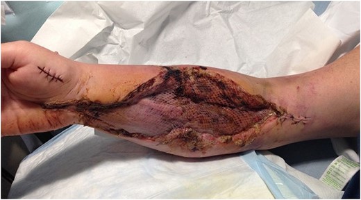Split-thickness skin graft used to close the fasciotomy wounds.