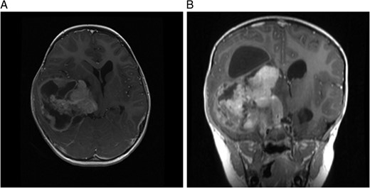 (A) MRI T1 pre-op and (B) coronal MRI pre-op with contrast.