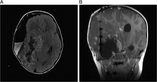 (A) MRI immediately following initial debulking of tumour showing a large subdural collection in a T2 FLAIR image and (B) coronal MRI post-op.