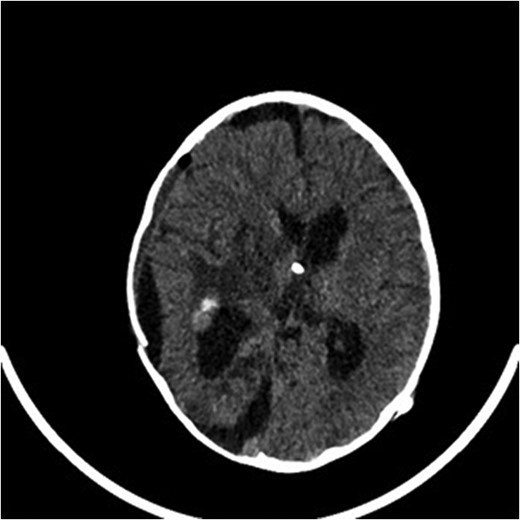 Computed tomography brain post VP shunt insertion