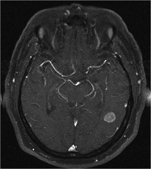Axial T1 with Gadolinium MRI showing left temporal lesion.