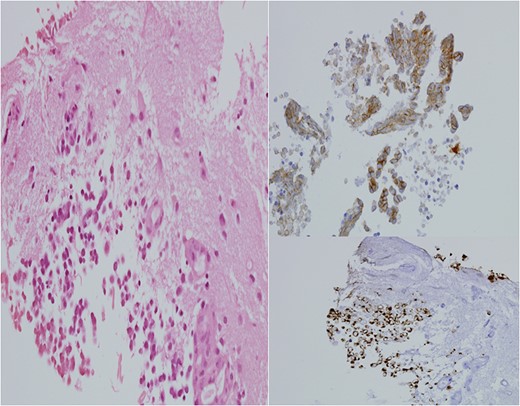 H&E stain for brain tissue, left. Immuno-stain for CK20, bottom right. Immuno-stain for CD56, upper right. ×400 magnification.