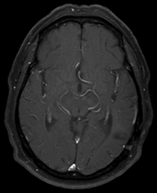 Axial T1 with Gadolinium MRI showing no evidence of recurrence at 10-year follow-up.