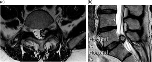 (a) Axial T2 weighted MRI showing a left sided L5/S1 synovial cyst impinging on the left S1 nerve root; (b) sagittal T2 weighted MRI showing a L5/S1 synovial cyst.