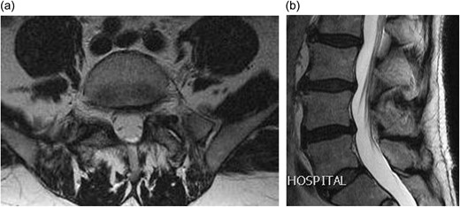 (a) Axial T2 weighted MRI showing complete resolution of the synovial cyst; (b) sagittal T2 weighted MRI showing complete resolution of the synovial cyst.