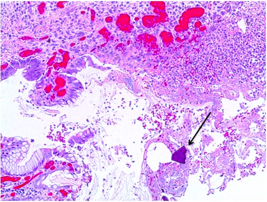 Colonic ulceration with necrosis and kayexalate crystal identified.