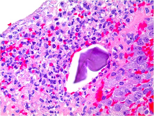 Kayexalate crystal within colonic mucosa and surrounding necrosis.
