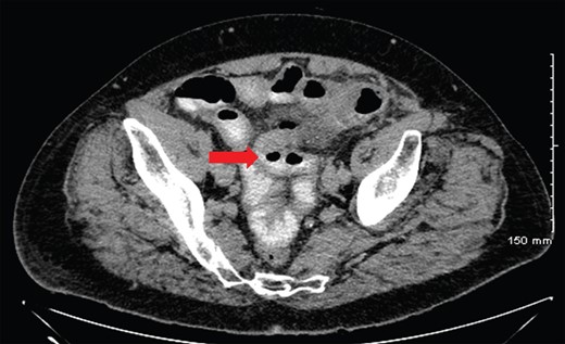 CT of abdomen with contrast revealing small pockets of intra-abdominal free air noted throughout the whole abdomen with mild fat stranding at the level of the mesenterium at the left paramedial lower abdomen and small amount of intrapelvic free fluid. A background of significant diverticular disease involving a redundant sigmoid which courses cranially to the umbilical region as well as scattered throughout the entire colon. This is suspicious for perforation within a hollow viscus (red arrow).