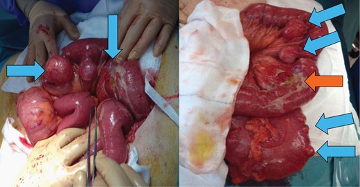Multiple large ileo-jejunal diverticulae were found throughout the small bowel (blue arrow) and sigmoid colon. There was a perforation noted of a single large distal jejunal diverticulum (orange arrow).
