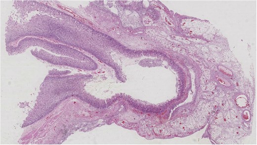 Histological examination showing H&E stained jejunal diverticulum.