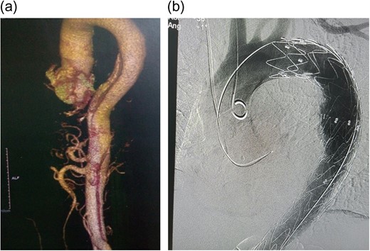 (a) CT Aortogram showing the dissection, 3D reconstruction; (b) immediate post-TEVAR showing contrast only in true lumen.