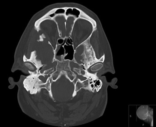 Axial CT images demonstrating bony involvement of the right mastoid and greater wing of the sphenoid.