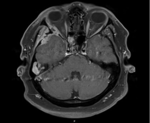 Axial MRI image demonstrating ocular involvement, with abutment of right lateral rectus muscle, as well as enhancement of temporal lobe.