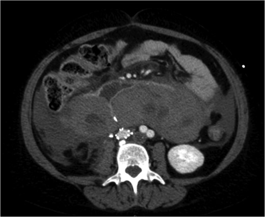 A venous phase abdominal CT demonstrating the end of the IVC filter strut penetrating the wall of the third part of the duodenum.