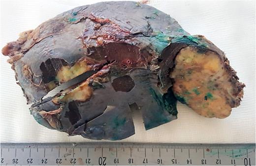 The macroscopic view of the resected spleen with two nodular and subcapsular tumors.