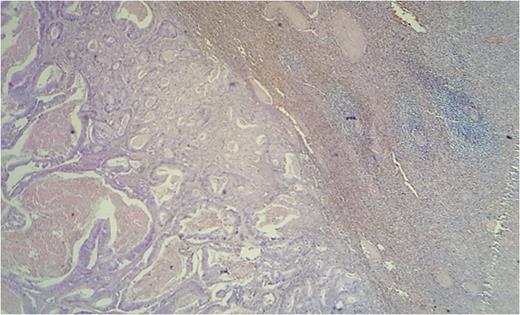 Histological aspect of the tumor showing a glandular pattern with large focis of necrosis (HES×10).