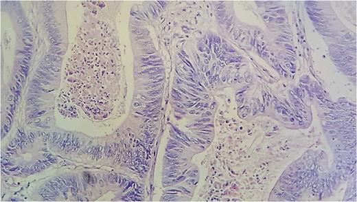 High power view of the tumoral glands lined by columnar cells with abundant eosinophilic cytoplasm and irregular nucleis (HES×40).