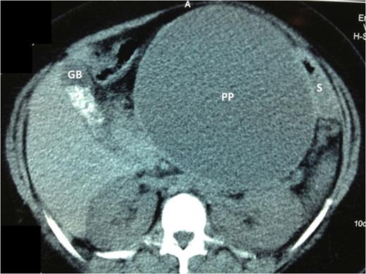 Axial cuts of a contrast enhanced CT scan of the abdomen. The large pancreatic pseudocyst (PP) is seen centrally. There is a uni-locular cavity measuring 15 × 17 cm2. The pseudocyst displaces the stomach (S) postero-laterally, but it remains closely applied to the PP wall. The gallbladder (GB) is clearly outlined on these cuts and the gallstones are seen as radio-dense opacities within its lumen.