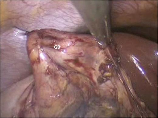 Trans-cutaneous polypropylene sutures (arrows) are used to execute the ‘hanging maneuvre’ that elevate the GB toward the antero-lateral abdominal wall. This puts Calot's triangle under stretch, thereby facilitating dissection of cystic duct and artery with electrocautery.