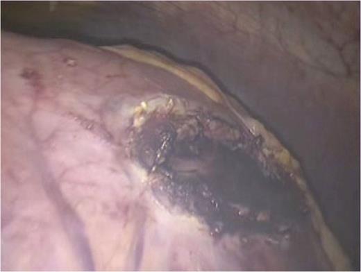 Cystogastrostomy was performed using the anterior approach. An incision was made in the anterior wall of the body of the stomach to allow entry into the gastric lumen.