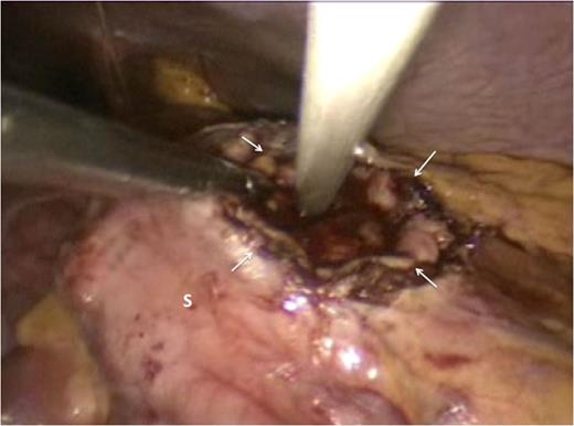 The gastric lumen was entered through the incision at the anterior stomach wall (margins indicated by white arrows). Conventional straight laparoscopic instrument can be seen developing an tunnel at the posterior stomach wall at the area where bulging from the pseudocyst is most prominent.