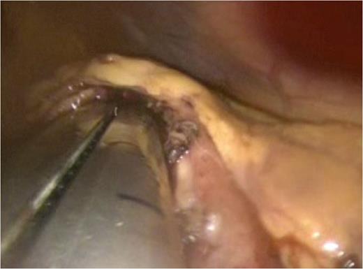 An endo-GIA articulating stapler is seen entering the anterior gastrotomy. One jaw of the stapler has been passed into the pseudocyst lumen and the other into the gastric lumen. The jaws have been approximated now in preparation for the creation of a stapled cystogastrostomy.