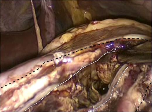 The incision at the anterior stomach wall (outlined by the broken black line) is retracted to allow access to the posterior stomach wall. An endo-GIA stapler has been fired to create a stapled anastomosis (outlined by the broken white line) between the posterior wall of the stomach and the anterior wall of the pancreatic pseudocyst. As a result the pseudocyst is opened widely to facilitate drainage of fiuid and debris into the gastric lumen.