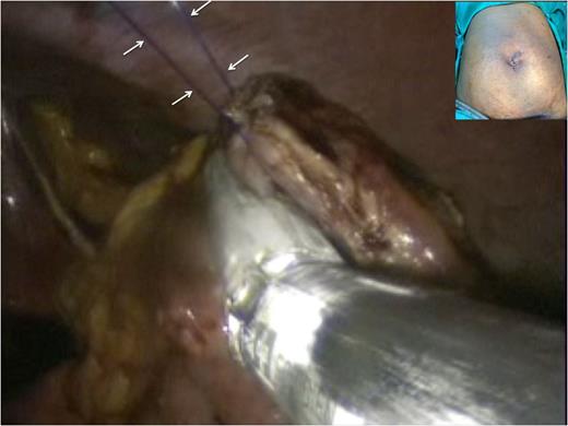 The ‘hanging manoeuvre’ is again used to suspend the margins of the anterior gastrotomy using trans-cutaneous polypropylene sutures (white arrows). This facilitates closure of the anterior gastric incision with two fires of an endo-GIA articulating stapler. The single ‘S’ incision was then closed (inset).