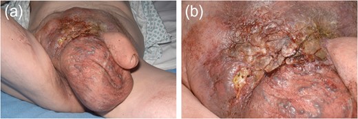 Photographs of massive in guinoscrotal mass.