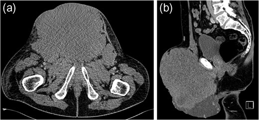 Computed tomography of the abdomen and pelvis.