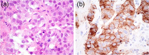 Histopathological and immunohistochemistry findings consistent with seminoma.