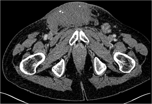 Computed tomography of abdomen and pelvis post-chemotherapy.