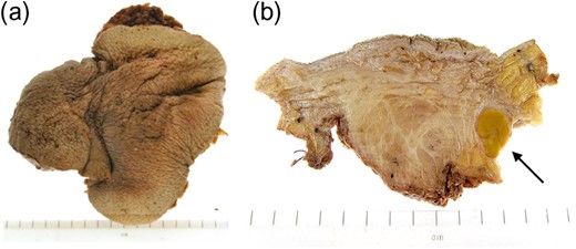 Macroscopic appearance of right testis with scrotal skin and pelvic lymph nodes following right inguinal orchidectomy.