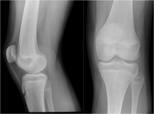 AP and lateral radiographs of the knee from the time of initial injury.