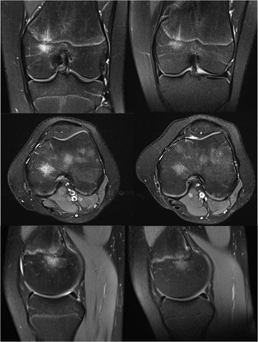 MRI images of the knee at 9 (left) and 13 months (right) after initial injury.