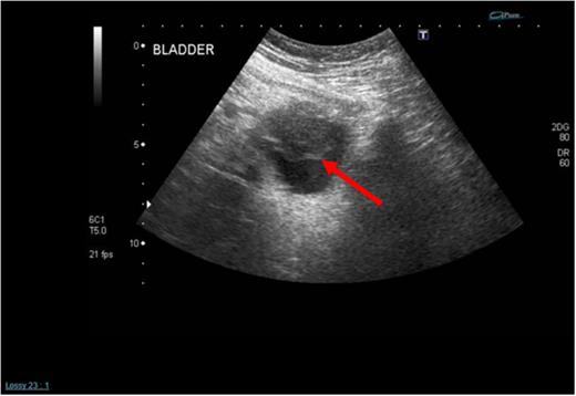 Initial admission USS of the urinary bladder demonstrating a solid mass within it (see red arrow).