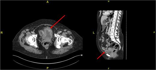 Cross-sectional (left) and sagittal (right) CT images of the abdomen and pelvis demonstrating a thickening of the anterior bladder wall at the site of the first TURBT (see red arrows).
