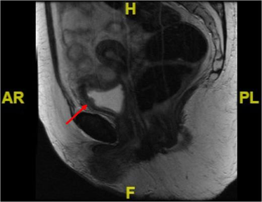Sagittal MRI image of the pelvis showing irregularity in the anterolateral bladder wall at the site of resection (see red arrow).