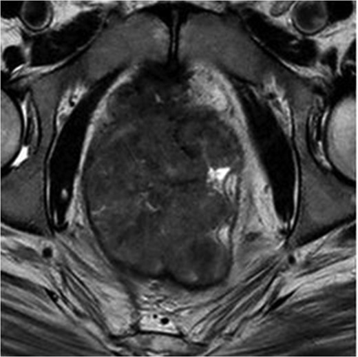 MRI pelvis. T2 waited axial image through lower pelvis through the large polypoid rectal tumour with T3 extension involving the CRM.